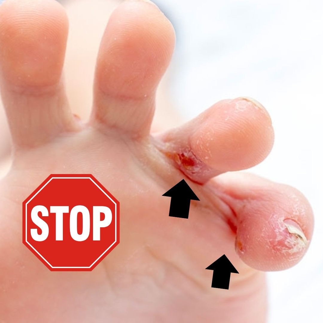 ToeRelief (2 unidades) - Bem-estar Total Para Seus Pés